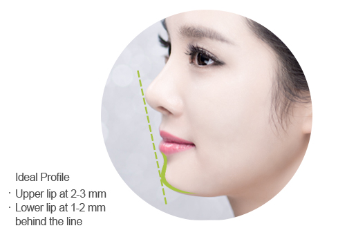 pointy chin implant